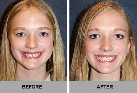 Invisalign Before And After Photos