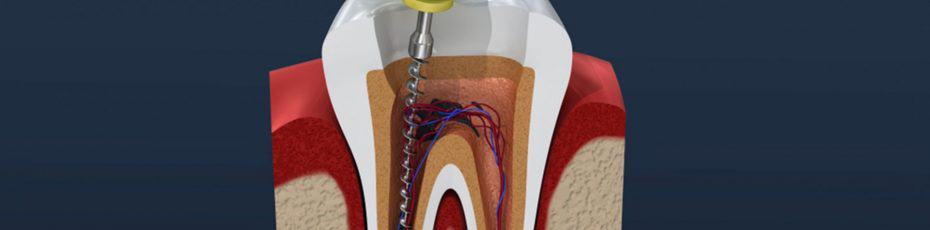 don’t be afraid of a root canal