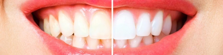 in office teeth whitening vs diy teeth whitening