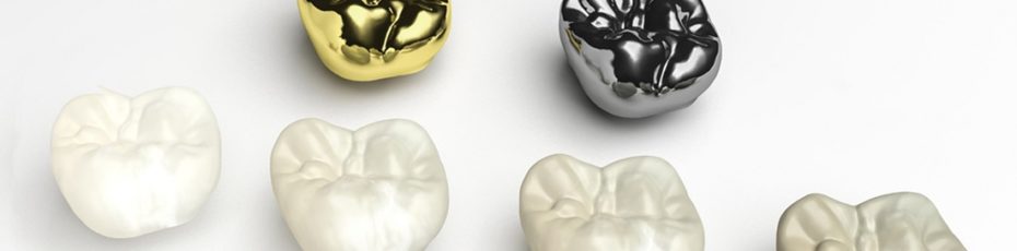 when is it time to replace your dental crown with a new one