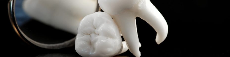 why and when to have your wisdom teeth pulled