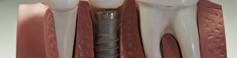 key facts about dental implants