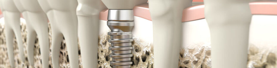 what is a recovery time for dental implants